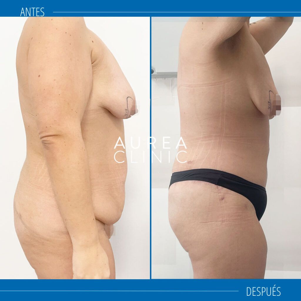 abdominoplastia circunferencial fotos antes y después