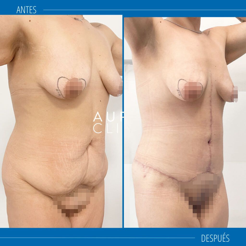 abdominoplastia circunferencial fotos