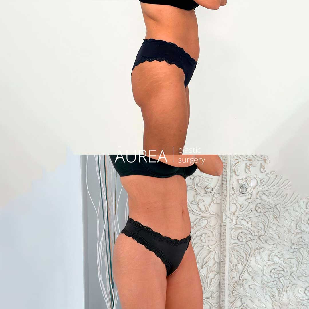 aumento de gluteos Sevilla grasa
