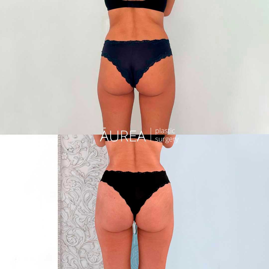 aumento-de-gluteos-lipofilling-antes-y-despues