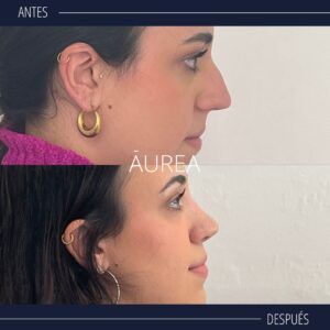 rinoplastia perfil antes y despues