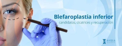 blefaroplastia inferior Sevilla
