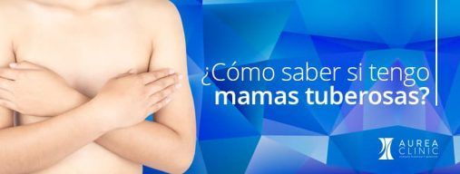 Cómo saber si tengo mamas tuberosas