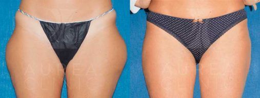 liposucción Sevilla Agualipo cartucheras