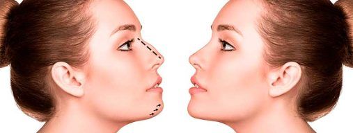 Perfiloplastia Sevilla | Aurea Clinic
