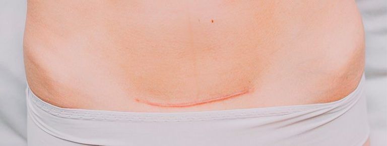 eliminación de cicatrices en Sevilla, medicina estética facial