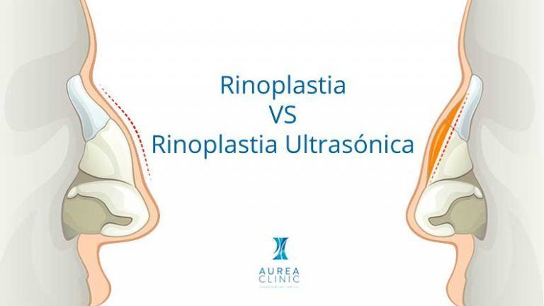 rinoplastia tradicional VS rinoplastia ulrasónica