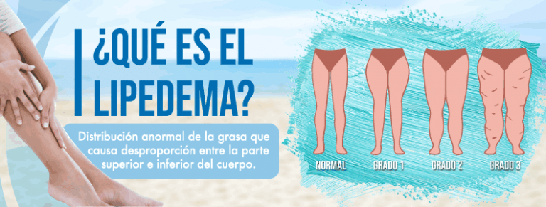 infografia lipedema causas tratamientos solucion