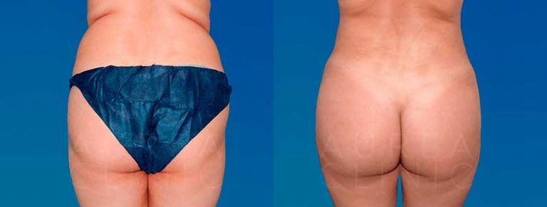 lipofilling glúteos antes y después
