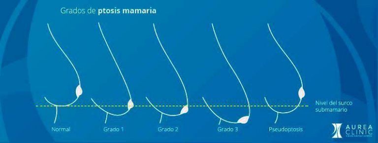 Mastopexia sin prótesis Sevilla
