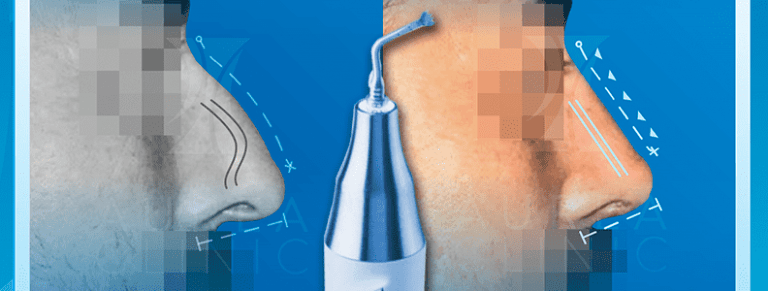 rinoplastia ultrasónica en Sevilla antes y después