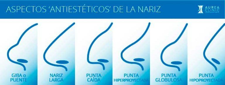 aspectos anti estéticos de la nariz
