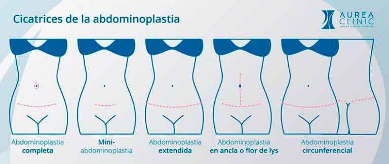 cicatrices de la abdominoplastia Aurea Clinic