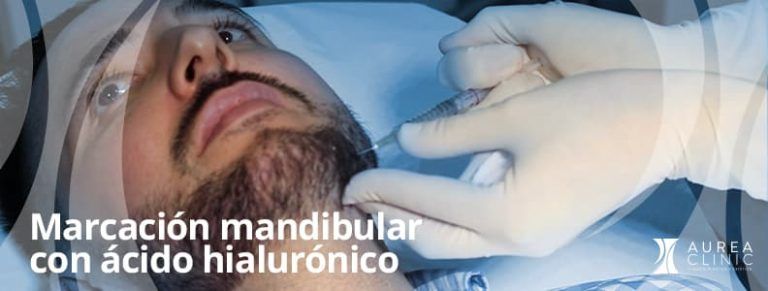 Marcación mandibular con ácido hialurónico en Sevilla