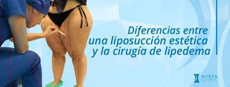 Liposucción estética y lipedema diferencias