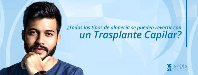 tipo de alopecia para un trasplante capilar Sevilla
