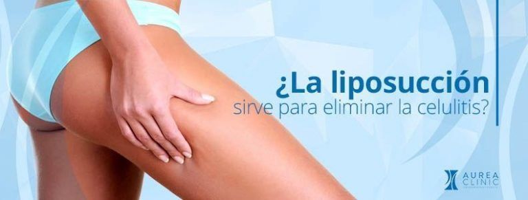 liposucción elimina celulitis Sevilla