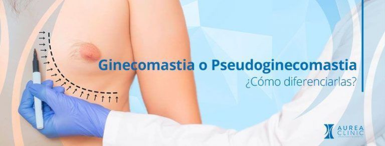 ginecomastia y pseudoginecomastia diferencias