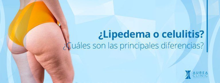 diferencia entre lipedema y celulitis Sevilla