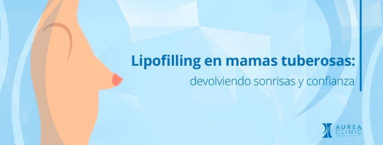 lipofilling mamario mamas tuberosas Sevilla