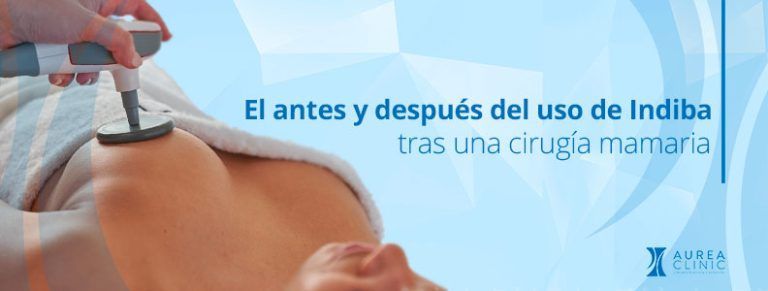 El antes y después del uso de Indiba tras una cirugía mamaria