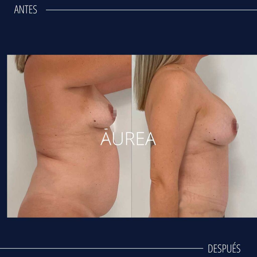 foto abdominoplastia antes y después de perfil