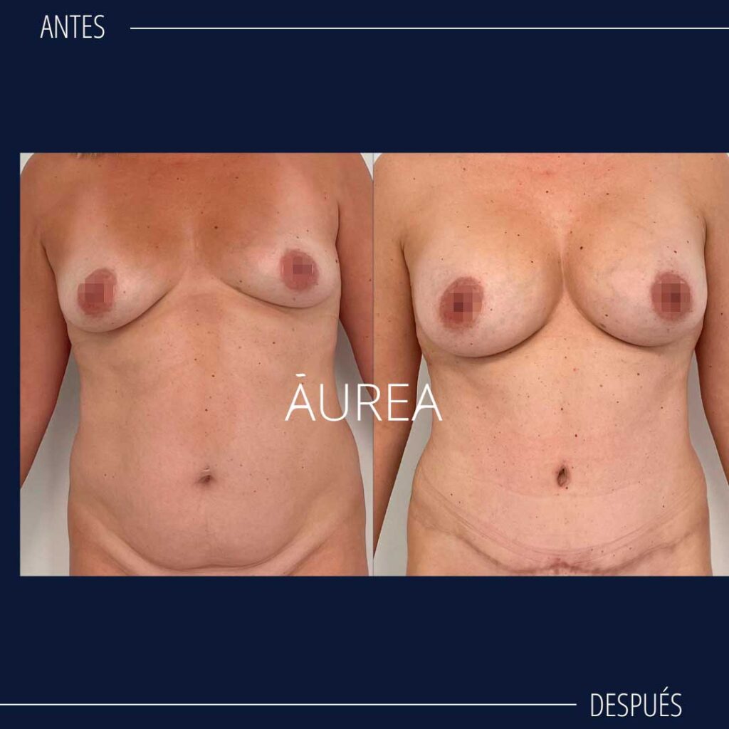 foto de resultados abdominoplastia
