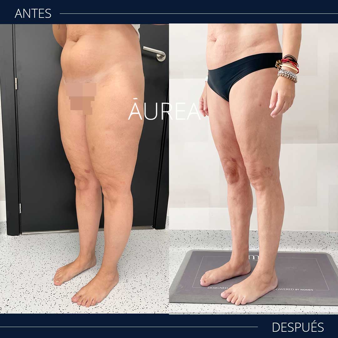 fotos lipedema antes y después