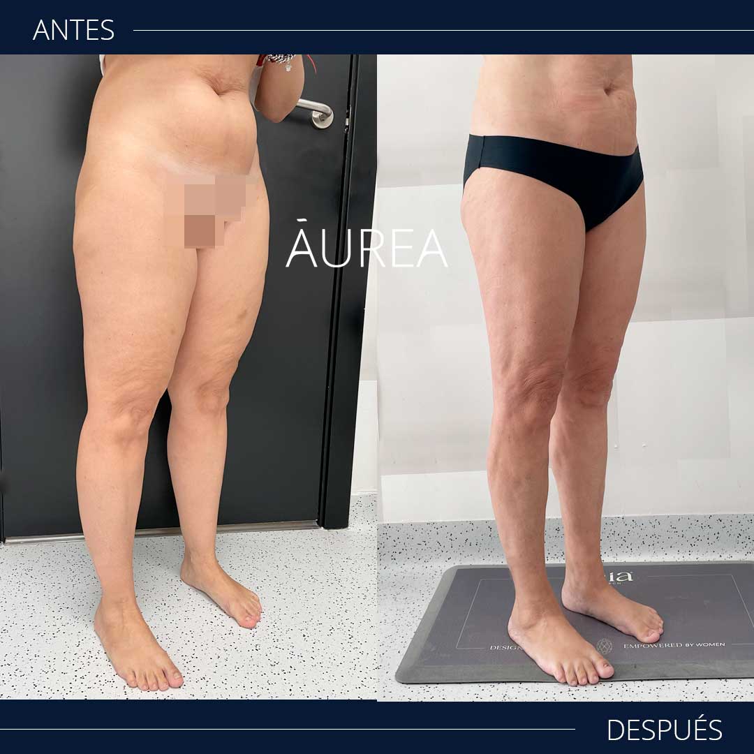 lipedema fotos escorzo