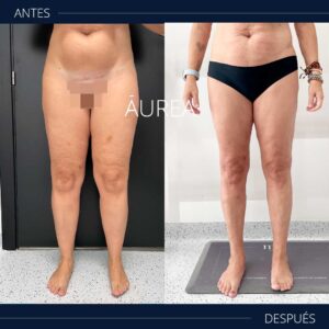 lipedema piernas fotos
