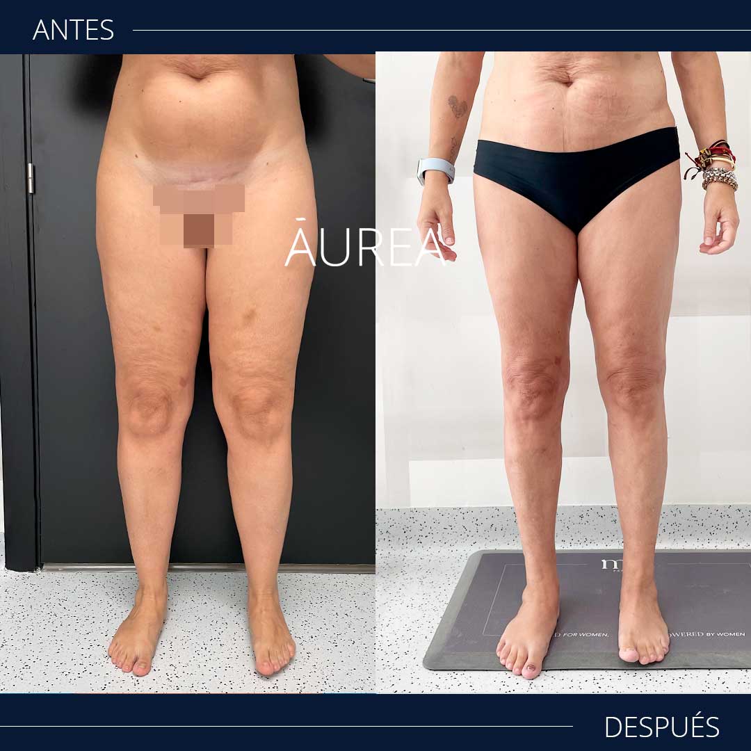 lipedema piernas fotos