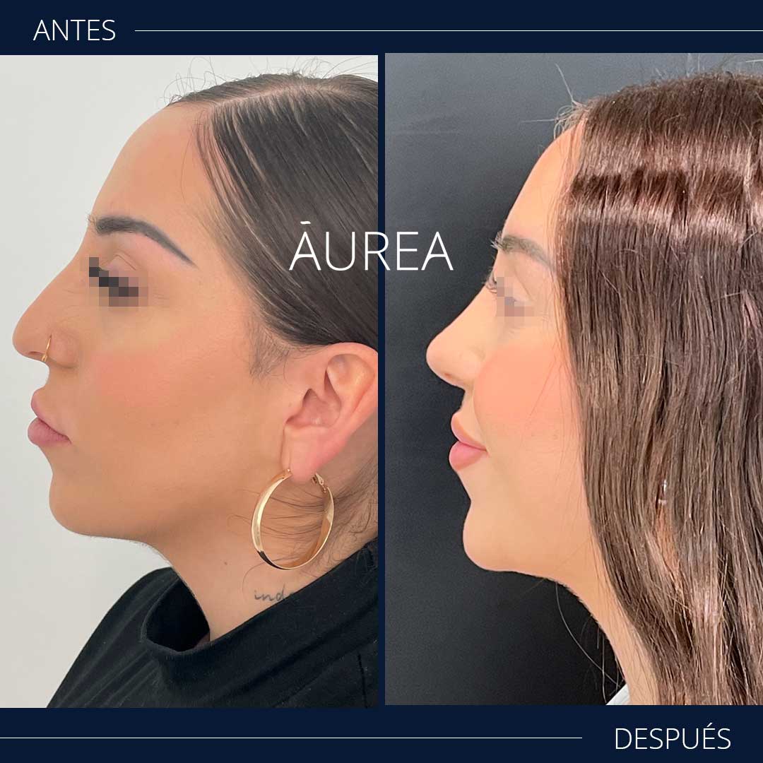 resultados rinoseptoplastia antes y después perfil izquierdo