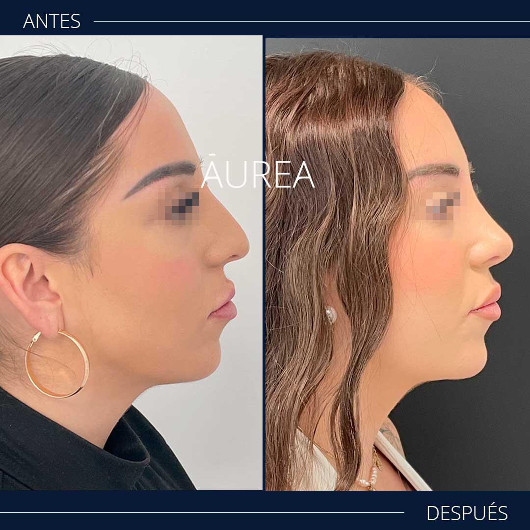rinoseptoplastia antes y después perfil deerecho