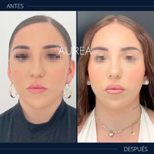 resultados rinoseptoplastia antes después frontal