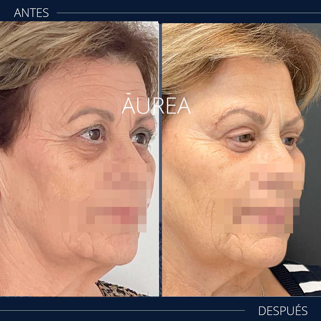 blefaroplastia antes y después en escorzo