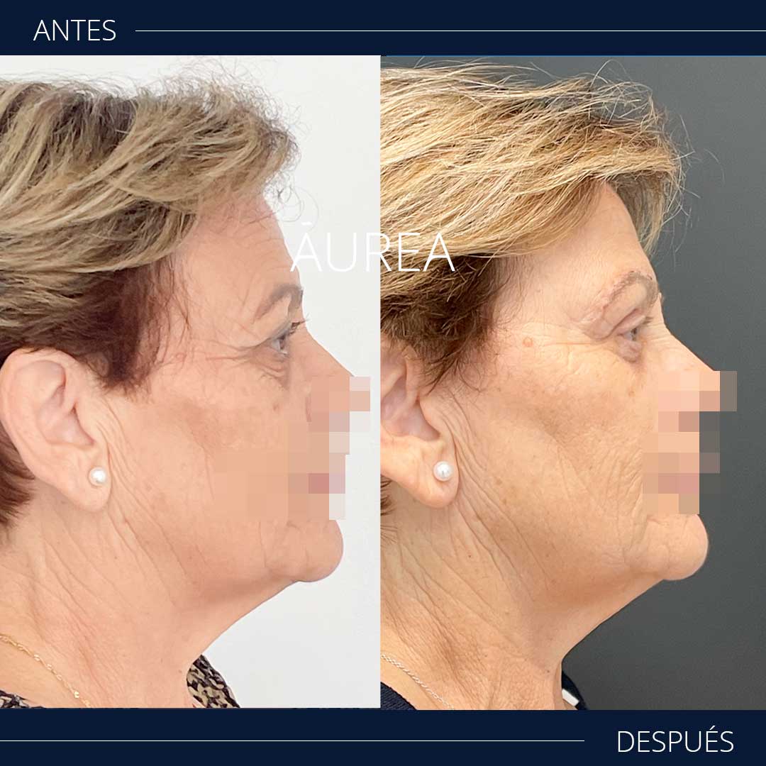 blefaroplastia antes y después de perfil