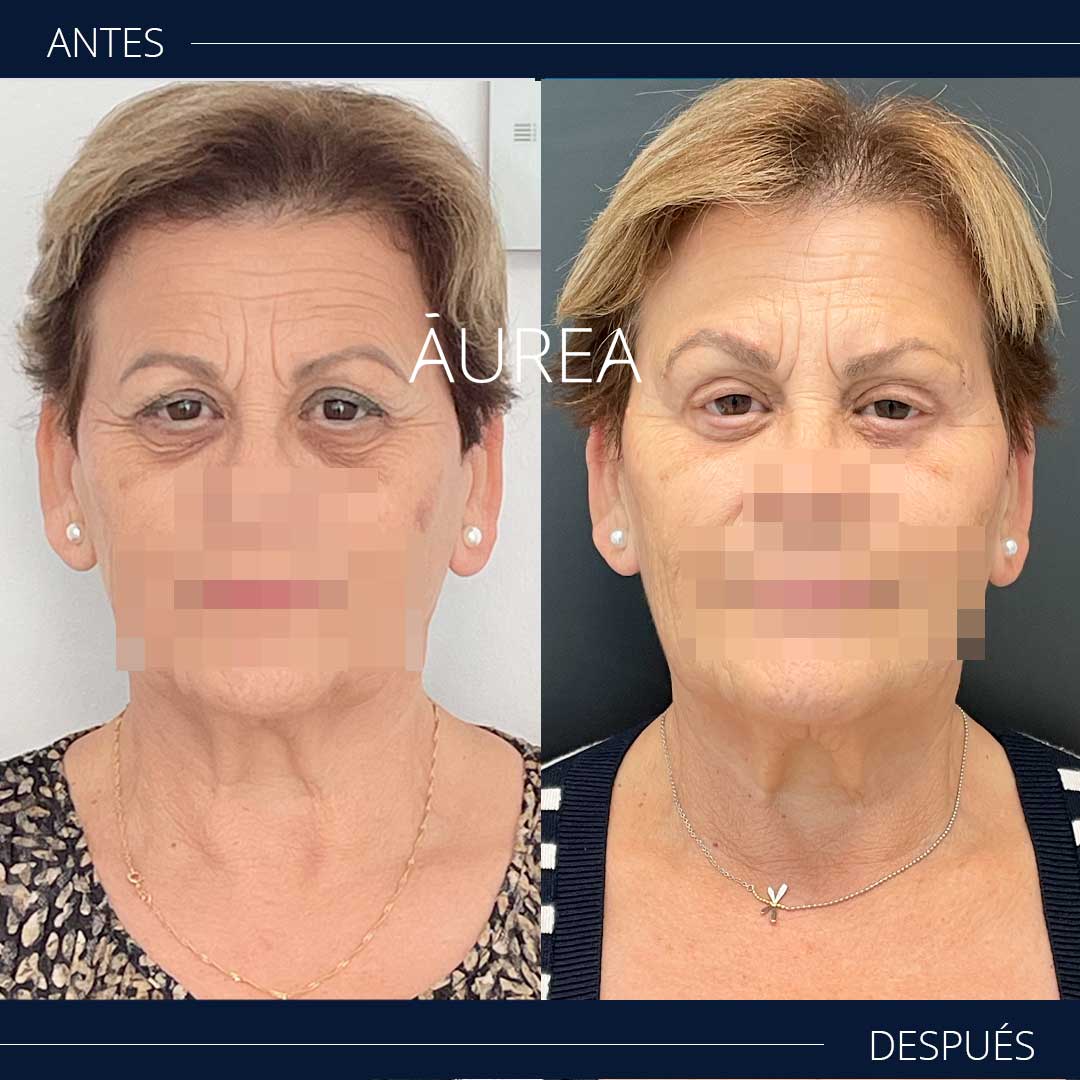 blefaroplastia antes y después de frente