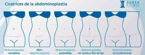 cicatrices de la abdominoplastia Aurea Clinic