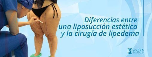 Liposucción estética y lipedema diferencias