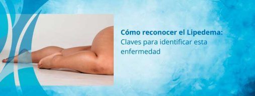 ¿Cómo identificar la enfermedad de Lipedema?
