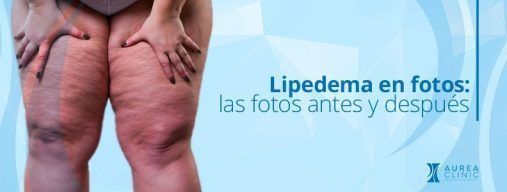 lipedema fotos sevilla