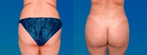 lipofilling glúteos antes y después