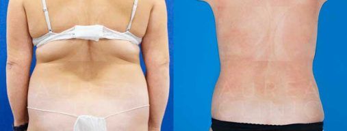 Liposucción de flancos | Liposucción Sevilla