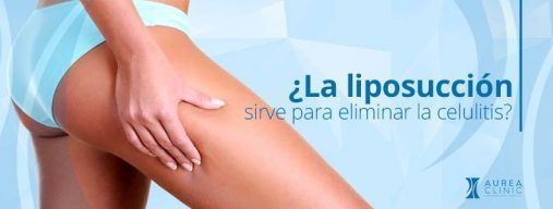 liposucción elimina celulitis Sevilla