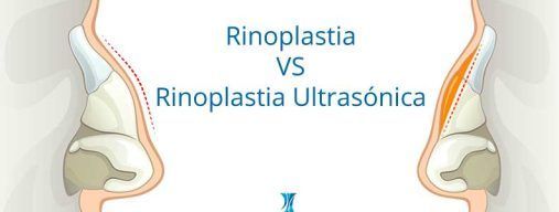 rinoplastia tradicional VS rinoplastia ulrasónica